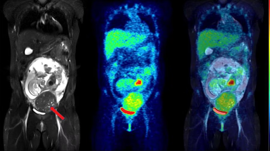 MRI during pregnancy