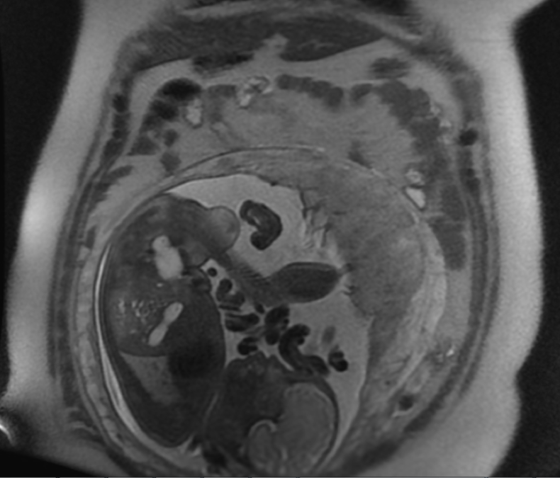 pregnancy mri scan