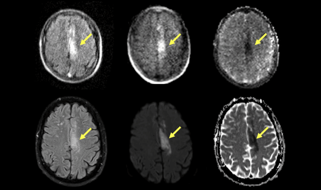 Dementia and Alzheimer's Disease