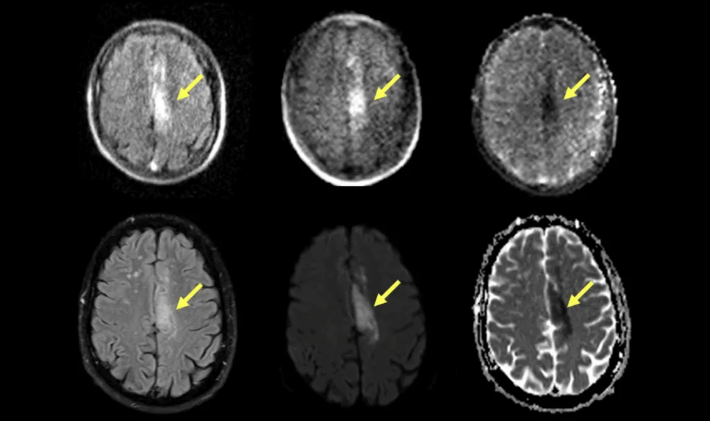 Dementia and Alzheimer's Disease