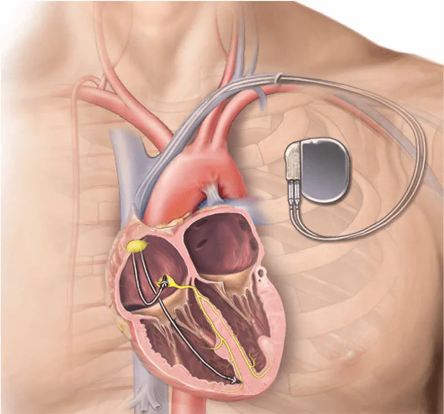 Inserting A Pacemaker 9Ec40B
